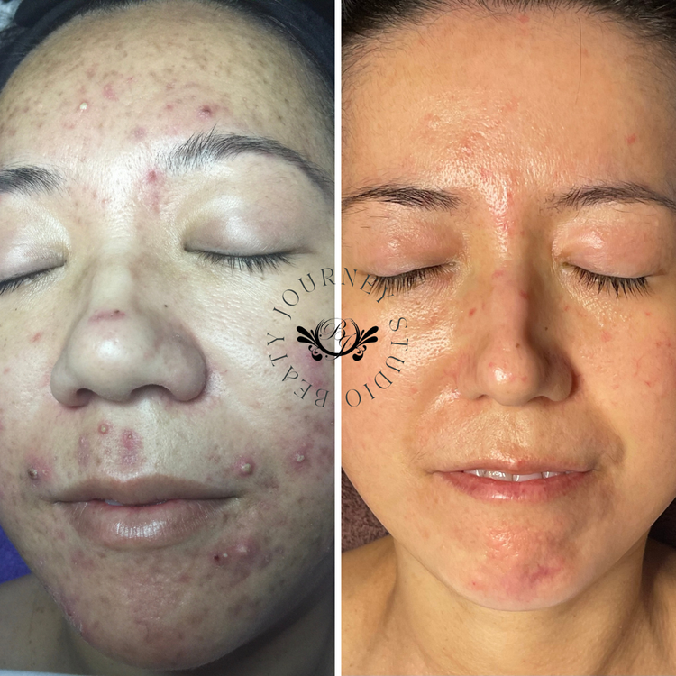Acne Skin